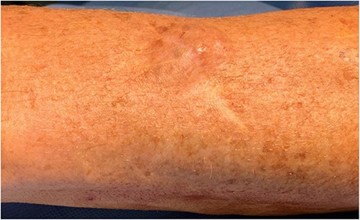 Clinical photograph of lump with the left side of image pointing distally towards thumb.