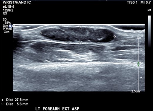 Ultrasound of left forearm with region of interest.
