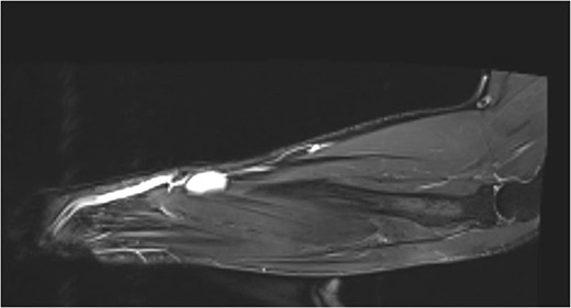 MR T1 coronal view of the left forearm showing concerning lump.