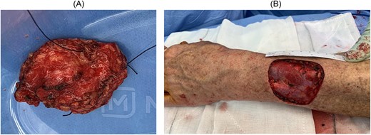 (A) Excision of lesion with cut undersurface in view with stitch at 12 o’clock; (B) surgical bed following excisional biopsy showing previous location of cut tumour.