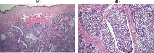 (A) Haematoxylin and eosin × 2. Low magnification view showing nodular nests of hyperchromatic basaloid cells with myxoid matrix, retraction artefact and peripheral nuclear palisading characteristic of BCC. There is also central cystic change because of degeneration of neoplastic cells; (B) haematoxylin and eosin × 10. Higher magnification of an area of cystic degeneration. Some of the cystic spaces are filled with red blood cells, mimicking vascular spaces.