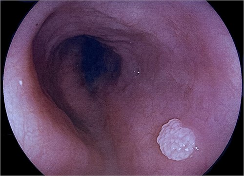 Endoscopic view of a 10-mm polypoid sessile lesion in the mid-oesophagus.
