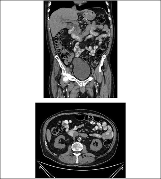 CT with oral contrast revealing a soft tissue ampullary lesion on axial and coronal images.
