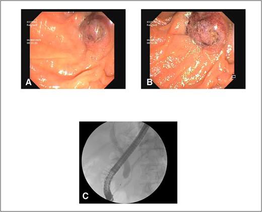 (A) and (B) malignant appearing soft tissue infiltrative mass within the ampulla of Vater seen on ERCP; (C) cholangiopancreatography showing stenosed distal third of the common bile duct along with a patent pancreatic duct.