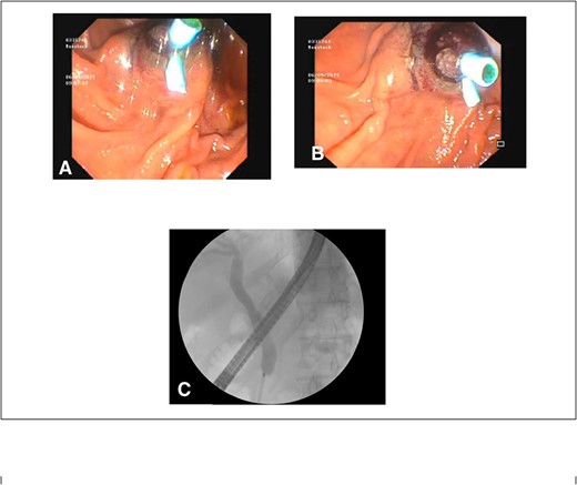 (A) and (B) endoscopic images showing a single plastic stent inserted into the distal CBD, protruding into the second part of the duodenum; (C) position confirmed on cholangiopancreatography revealing resolution of distal CBD filling defect.