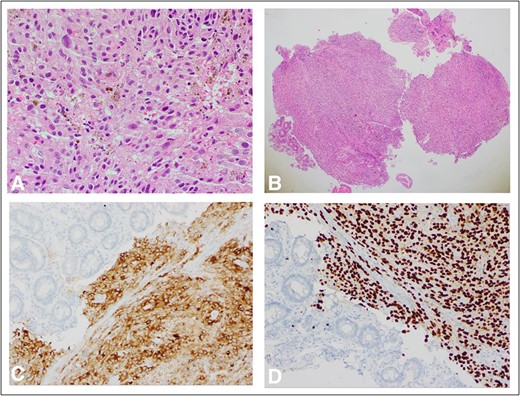 (A) H&E ×400 slide showing pigmented melanoma cells with surrounding normal tissue; (B) H&E ×40 slide with normal ampulla tissue on far left and tumour in centre; (C) MelanA ×200 stain with melanoma; and adjacent normal ampullary tissue on the left; cytoplasmic expression of MelanA/MART1 highlights how the melanocytes are obscured by a dense lymphocytic infiltrate than in the conventional H&E slide; (D) Sox10 stain ×200 similarly showing discoloration by malignant melanoma cells with surrounding normal ampullary tissue.
