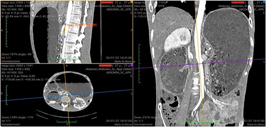 Computed tomography images showing a narrow aortomesenteric angle of 14.3° (sagittal section) and a massively dilated stomach, as seen on coronal and axial sections.