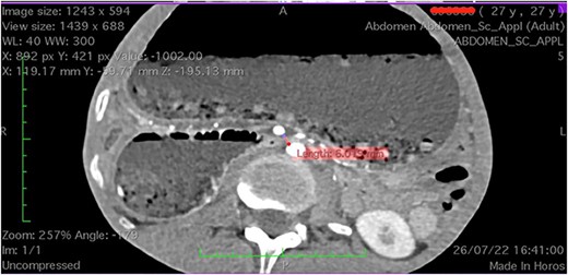 Computed tomography axial section showing a dilated stomach resulting from compression of third portion of duodenum.