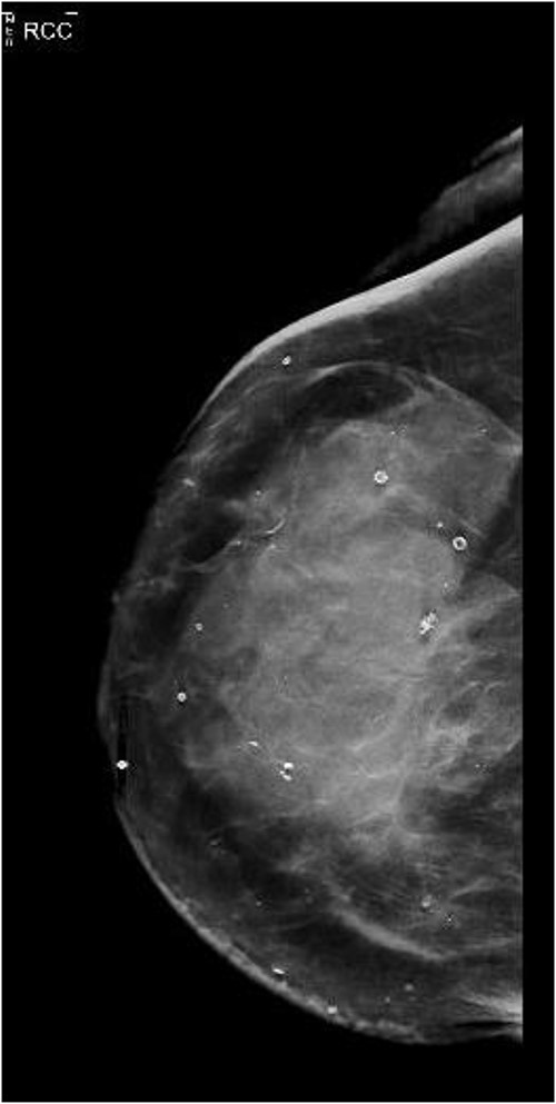 Diagnostic mammography of right breast, craniocaudal (CC).