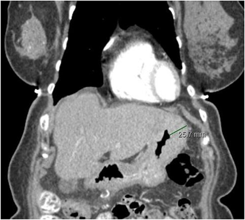 CT abdomen/pelvis displaying gastric wall thickening, coronal view.