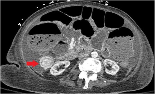 CT abdomen/pelvis displaying intussusception of terminal ileum.