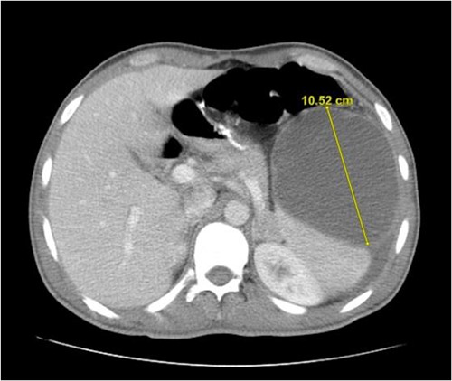 An abdominal contrast-enhanced computed tomography showing a cyst originating from spleen