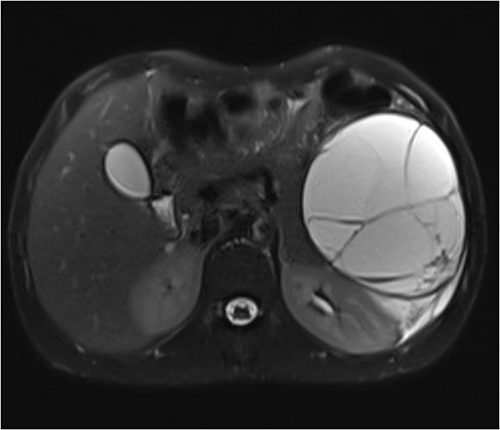 T2 abdominal contrast magnetic resonance image showing the cyst