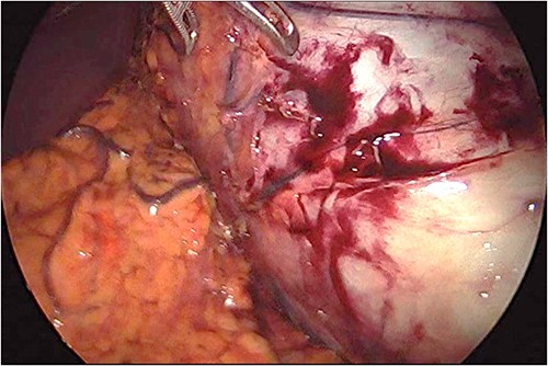 The cyst occupying most of the left upper quadrant