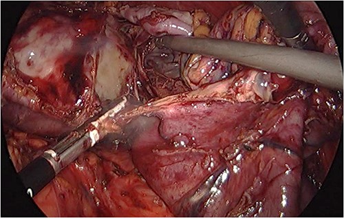 Resecting the cyst after aspiration