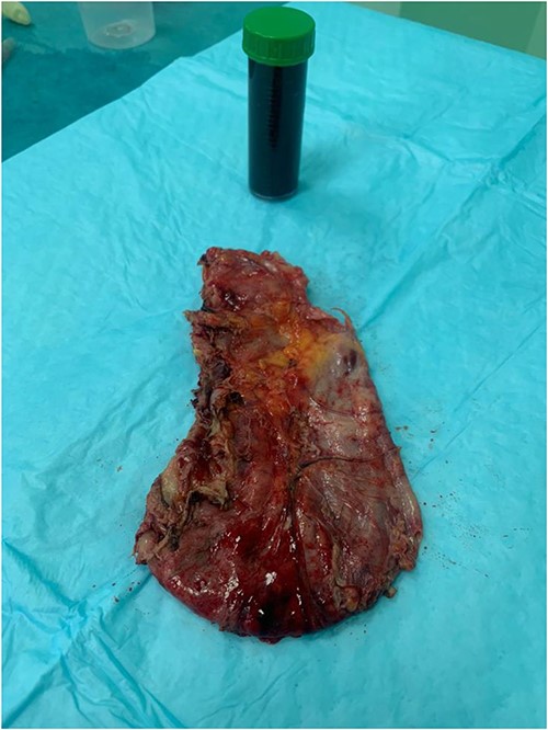 Resected cyst and the drained fluid