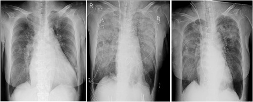 Chest radiographs obtained pre-operation (left), post-operation (middle) and 2 days post-operatively (right).