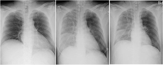 Chest radiographs obtained pre-operation (left), post-operation (middle) and 2 days post-operatively (right).