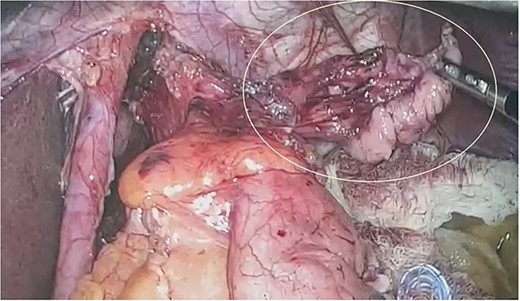 Tumor-like mass identified on the left lateral face of the distal third of the esophagus.