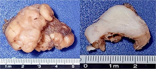 Macroscopic image of the tumor found, irregularly shaped tissue fragment measuring 4.3 × 2.9 × 2.1 cm.