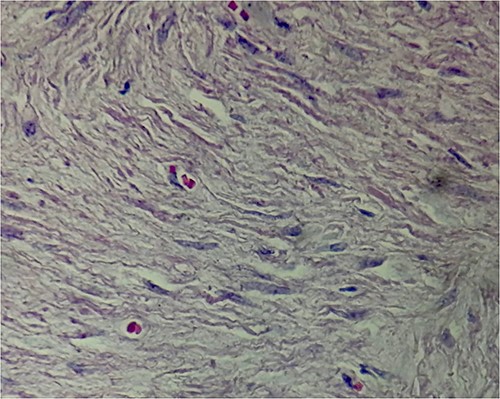 Fusiform hypercellular population in long and short bundles as well as hypercellular confluences with extensive myxoid edematous hypocellular areas.