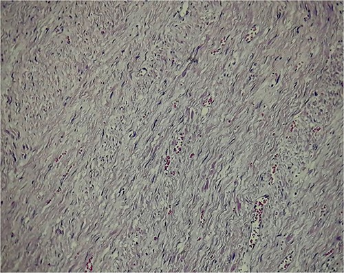 Abundant dilated congestive vascular structures; at higher magnification of spindle cells with pale acidophilic cytoplasm, elongated nuclei of vesicular chromatin, with smooth muscular characteristics.