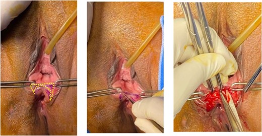 Butterfly-shape incision was made along the junction of posterior vaginal mucosa and rectal mucosa. Sharp dissection was done to separate anterior wall of rectal mucosa from posterior vaginal wall creating a good rectovaginal space.
