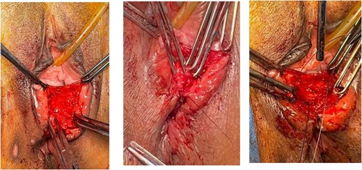 Identified anal mucosa, EAS and IAS. Anal mucosa was stitched interruptedly with an intraluminal knot. IAS was stitched with horizontal mattress.