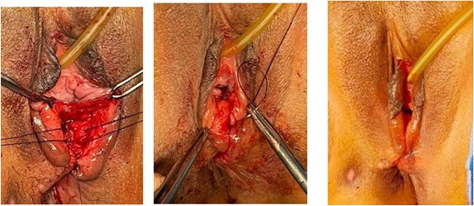EAS was stitched overlapping technique. Perineal muscle, vaginal mucosa and perineal skin were stitched. Continued with perineorrhaphy using PGA No. 2.0.