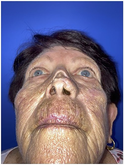 Worm’s eye view of the patient demonstrating nasal contour deformity due to squamous cell cancer resection and skin graft repair.