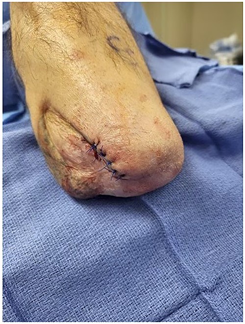 Post-operative view of the patient’s left below-the-knee stump after Leneva injection.