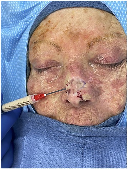 Intraoperative photo injecting Leneva AAM into the patient’s nasal defect.