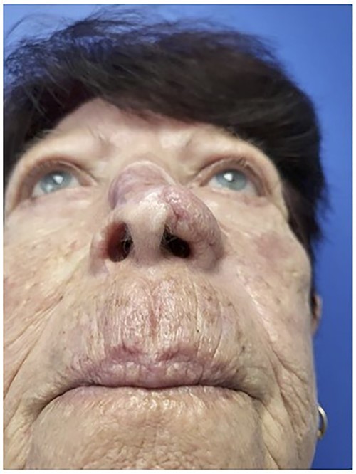 Worm’s eye view demonstrating incorporation of Leneva into the nasal defect.