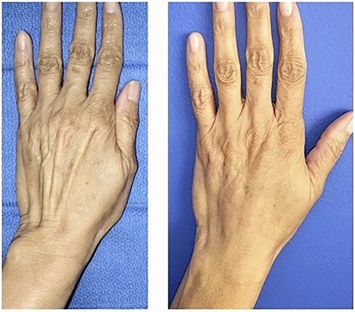 Before and after photo after injecting the dorsum of the left hand with Leneva.
