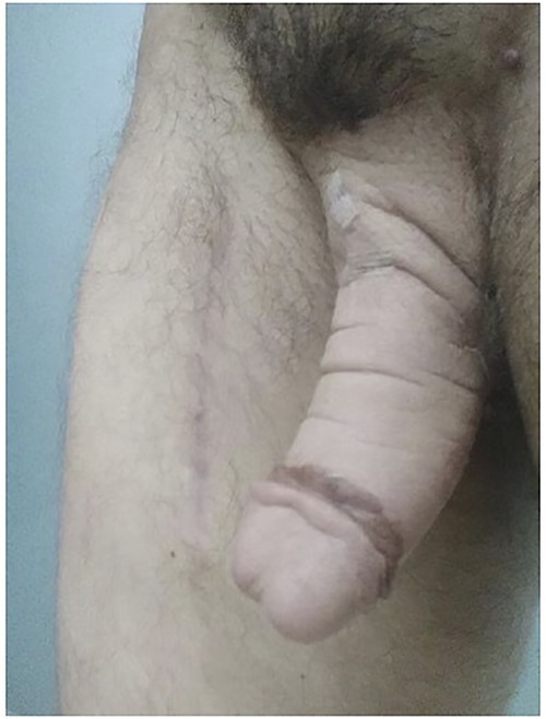 Post-operative view of the patient’s neophallus after Leneva injection.
