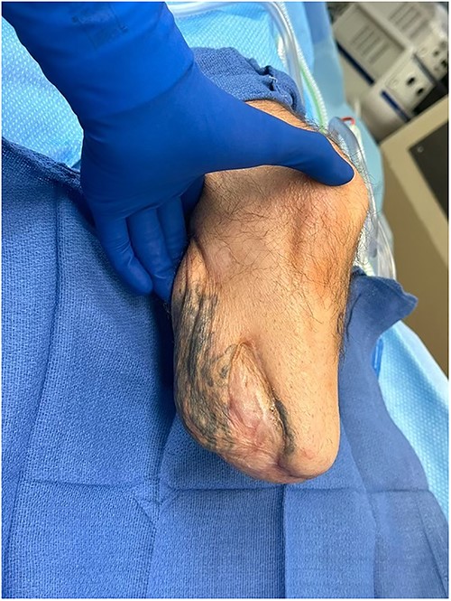 Pre-operative view of the patient’s left below-the-knee stump.