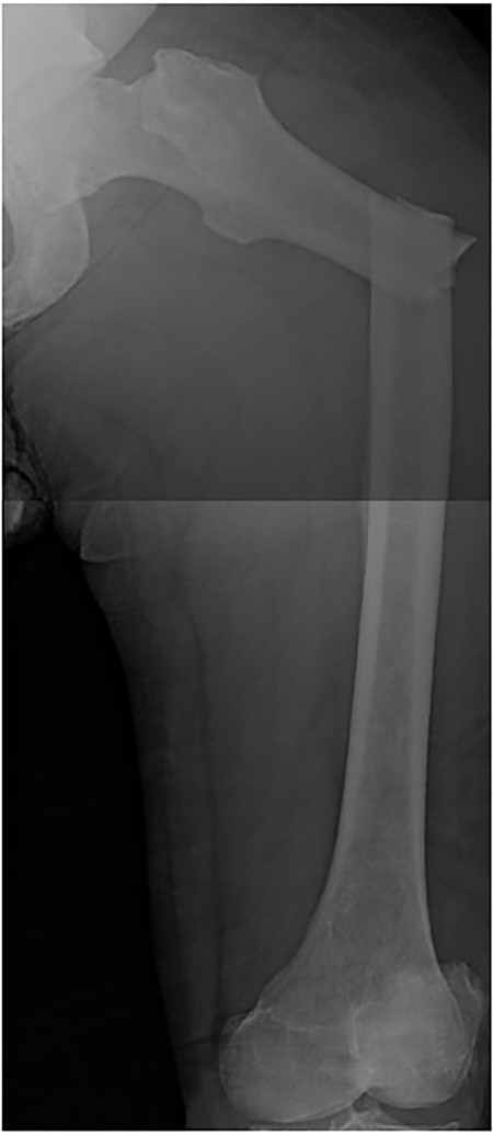 AP of left femur with transverse subtrochanteric fracture.