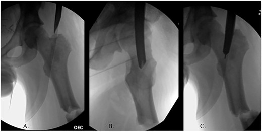 (A) Cannulated awl positioned medial to tip of GT on the AP XR; (B) cannulated awl positioned center of GT on the lateral XR; (C) entry reamer over guide pin on the AP XR.