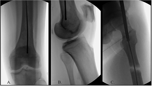 (A) Ball-tipped guidewire slightly lateral position at the knee on the AP XR; (B) ball-tipped guidewire too posterior at the knee on the lateral XR; (C) flexible reamer within the proximal femur abutting blastic lesions.