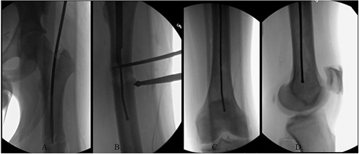 (A) Canulated cutter tool creating a new path in the proximal femur; (B) rigid canulated reduction rod directing the guidewire across a reduced fracture held with a proximal bone hook and distal ball spike pusher; (C) center positioned ball-tipped guidewire at the knee on the AP XR; (D) center positioned ball-tipped guidewire at the knee on the lateral XR.