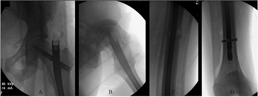 (A) AP radiograph of left hip with implant; (B) lateral radiograph of left hip with implant; (C) reduced fracture site with implant; (D) distal femur with implant.