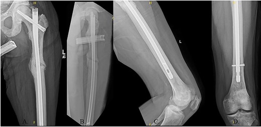 (A) 12-month post-operative AP radiograph of left hip; (B) 12-month post-operative lateral radiograph of left hip; (C) 12-month post-operative lateral femur radiograph; (D) 12-month post-operative AP distal femur radiograph.