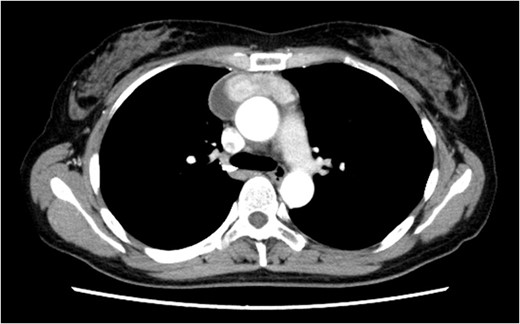 The chest CT scan showing an anterior mediastinal tumor.
