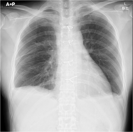 Chest X-ray on post-operative day 7 revealing no massive pleural effusion.