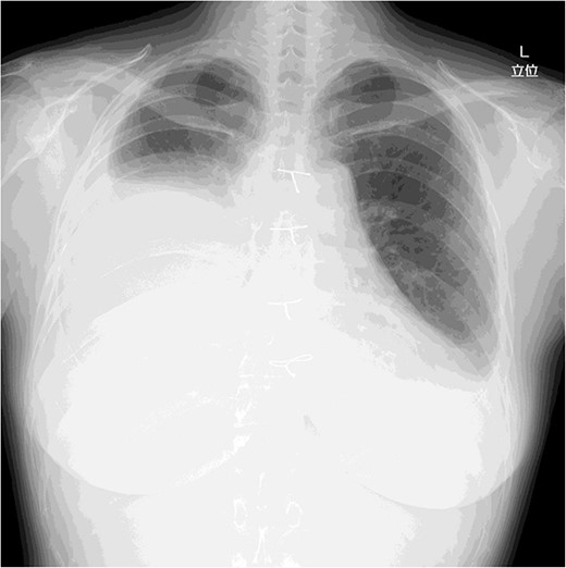 Chest X-ray on post-operative day 17 revealing massive pleural effusion.