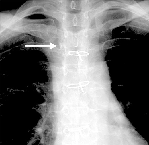 The lipiodol lymphography detected the suspicious location of the chyle leakage (arrow).