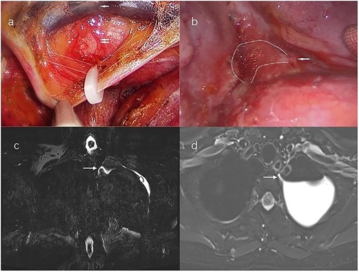 (a) Uniport video-assisted thoracic surgery (VATS) right supradiaphragmatic thoracic duct ligation; white broken lines mark the course of the thoracic duct; the single white arrow marks the aorta, the double white arrows mark the azygos vein. (b) Left lateral uniport VATS reveals that the thoracic duct fistula locates at the T2-T3 level; chylous pleural effusion flows from the fistula; the single white arrow marks the thoracic duct fistula; the white broken lines mark the chylous pleural effusion. (c) Magnetic resonance–thoracic discography reveals that the thoracic duct fistula is located at the left posterior part of the esophagus at the T2-T3 level; the single white arrow marks the thoracic duct fistula in the coronal view. (d) The thoracic duct fistula is connected to the pleural effusion in the Axial view; the single white arrow marks the thoracic duct fistula.