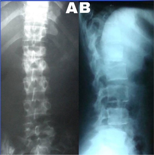 (A) Lumbar spine X-ray, anteroposterior view showed the collapse of the L1–2 intervertebral space. (B) Lumbar spine X-ray and lateral view showed L2 superior endplate erosion.