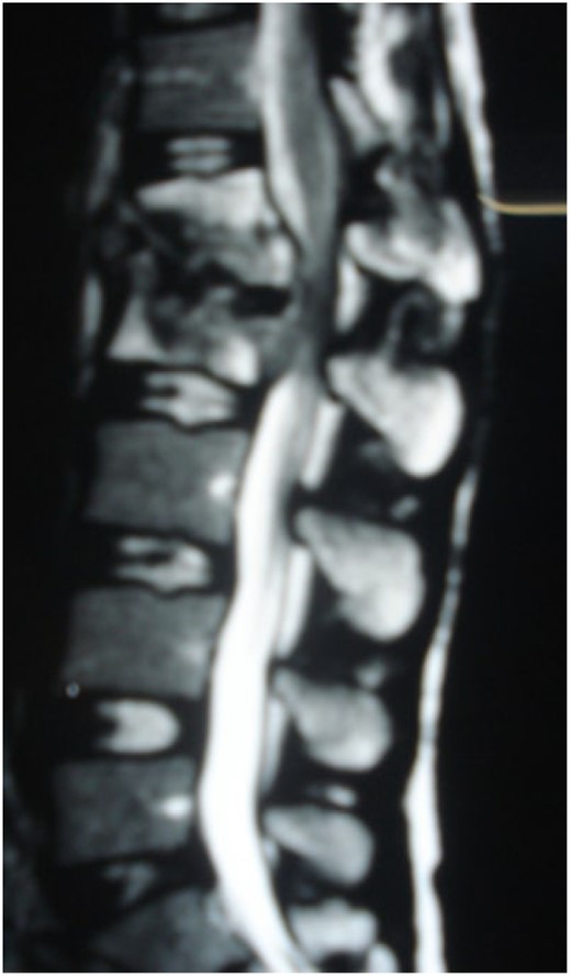 Sagittal T2-weighted MRI shows severe disco vertebral destruction, the formation of epidural abscess and compression of the spinal cord at the L1–2 level.