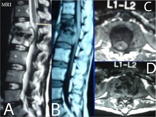Lumbar T1 and T2 consistent with an abscess at the L1–2 vertebral level. (A) and (B) showed that the height of the L1 and L2 vertebral bodies was markedly reduced and the dural sac and spinal cord were severely compressed by an abscess posterior to the vertebral body. (C and D) Axial T1 shows a well-defined paraspinal abscess. The anterior epidural abscess compresses the spinal cord.
